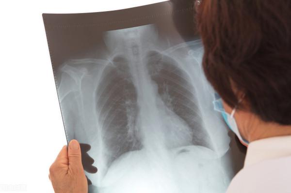 什麼是“肺大皰”？體檢時被查出該怎麼辦？呼吸科醫生道出了真相