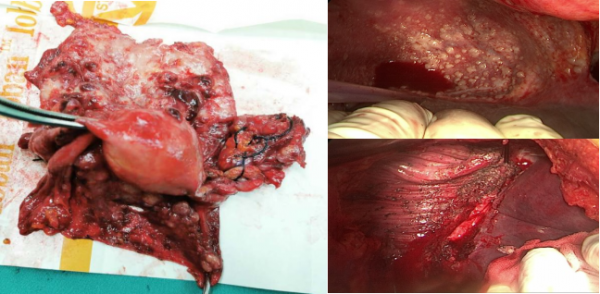 「卵巢醫聲」尼拉帕利單藥一線維持治療實現HRD陽性（罕見RAD51C胚系突變）晚期卵巢癌患者獲益