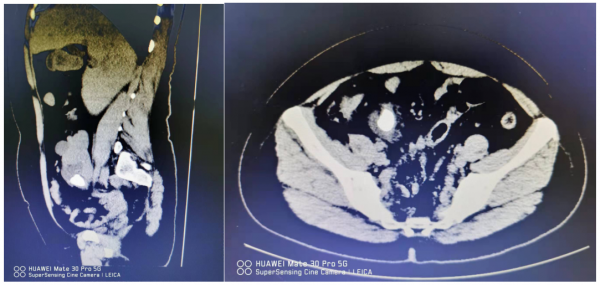 右腎生在盆腔 還長了3cm的結石 哈醫大一院群力泌尿外科團隊精準治療罕見異位腎結石