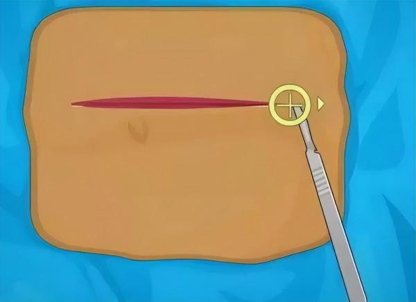 手術時，為啥切開面板幾乎不出血，生活中稍微劃破就會流血呢？