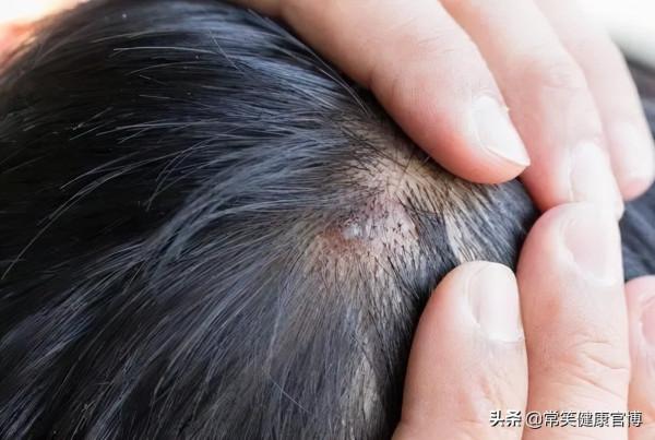 一粒一粒,一片一片,一塊一塊,頭皮上究竟能長出多少“髒東西” 一粒一粒,一片一片,一塊一塊,頭皮上究竟能長出多少“髒東西”