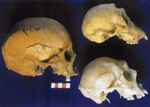 專家在1997年曾對“猴娃”曾繁勝的遺骨進行檢測,結果如何? 專家在1997年曾對“猴娃”曾繁勝的遺骨進行檢測,結果如何?