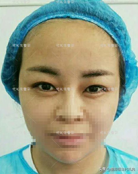 48歲女士面部提升&plus;雙眼皮，術後三個月，對比改變年輕15歲