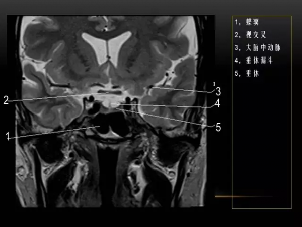 MRI下眼部及鼻竇解剖