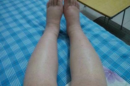 中醫吳勝利:老年人常見的水腫該怎麼治療? 中醫吳勝利:老年人常見的水腫該怎麼治療?