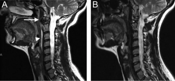 頸椎少見的3種鈣化性疾病 頸椎少見的3種鈣化性疾病