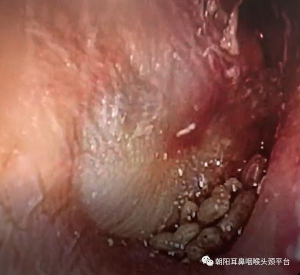 耳朵進了東西怎麼辦？