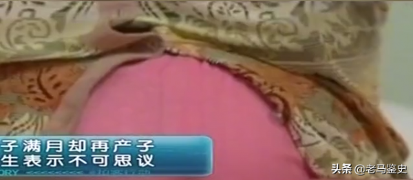 頭胎剛滿月，產婦馬上又要生第二胎？醫生：從醫20年從未見過