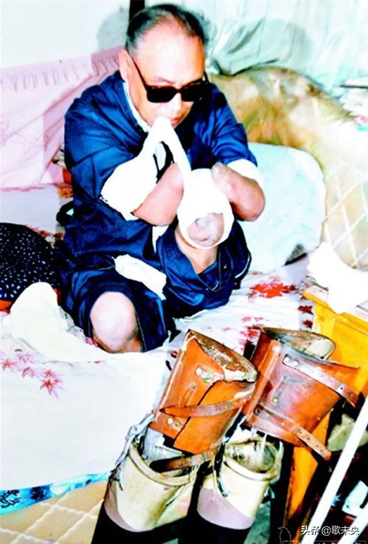 長津湖戰役失去四肢左眼，他吞下自己的眼球活命，昏迷93天后醒來