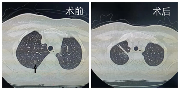 【我為群眾辦實事】以肺亞段為中心精準肺切除治療早期肺癌