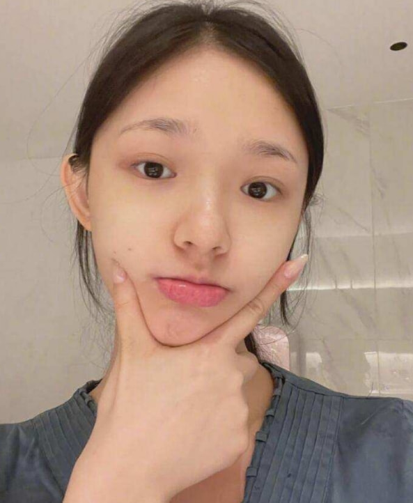 “星女郎”林允曬微整影片，針孔滲血珠，臉部浮腫，網友：太狠了