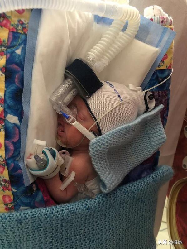 倆胎兒在媽媽子宮裡搶食，弟弟出生時不到1斤重，奇蹟般活了下來