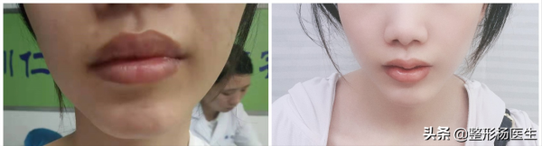 為什麼anglababy的微笑唇這麼受歡迎!我來告訴你答案 為什麼anglababy的微笑唇這麼受歡迎!我來告訴你答案