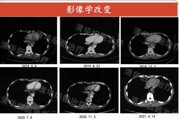 有效抑制癌症復發轉移，新案例證明：細胞免疫治療這點強