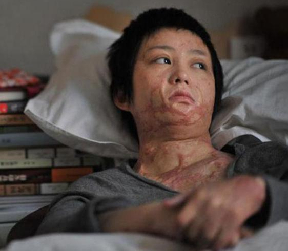 十年前，因拒絕官二代追求，被潑汽油燒至毀容的女孩，你還好嗎？