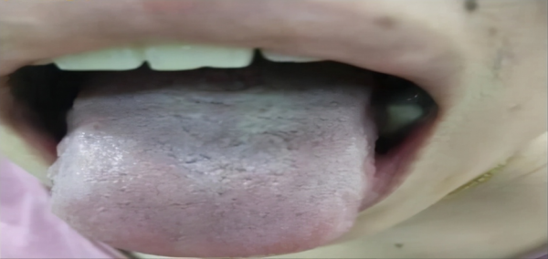 兩個位置測血瘀,一箇中成藥化淤血,4種血瘀體質瞭解一下 兩個位置測血瘀,一箇中成藥化淤血,4種血瘀體質瞭解一下