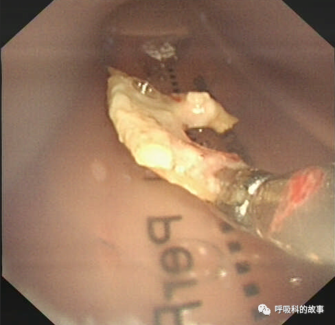 咳嗽半年反覆肺炎為什麼治不好 細看影像發現端倪緣是異物堵塞