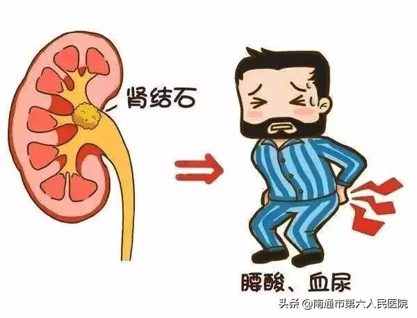 腎結石 | 體外碎石效果不佳應該咋辦？
