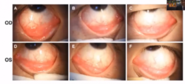 COVID-19眼部感染，何為真？何為假？丨APVRS 2021