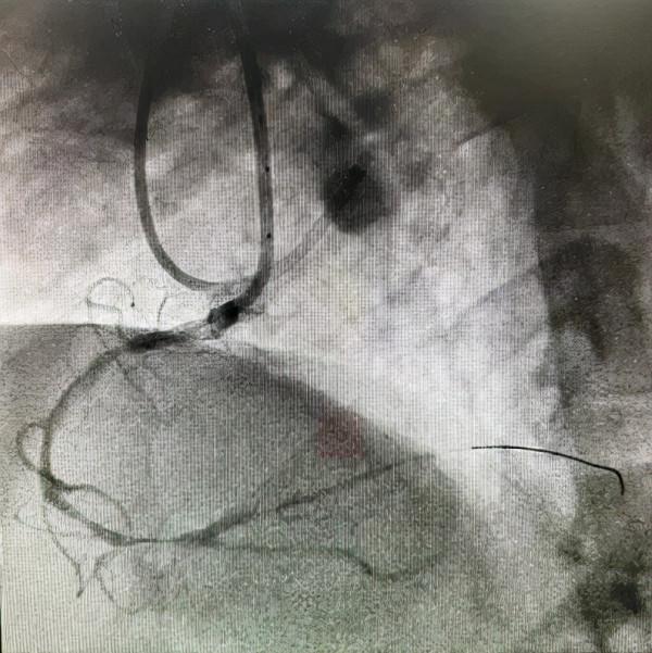 再克技術堡壘，巧破閉塞病變