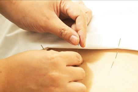 便秘可以透過針灸搞定嗎？值得收藏