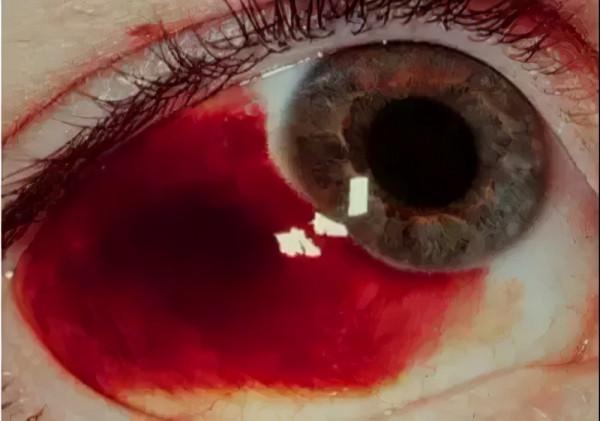 眼睛總是有“紅血絲”？可能是這5種眼病在作祟