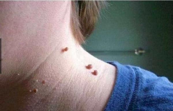 脖子上長了“小肉粒”，礙事嗎？要不要治療？醫生說明白了