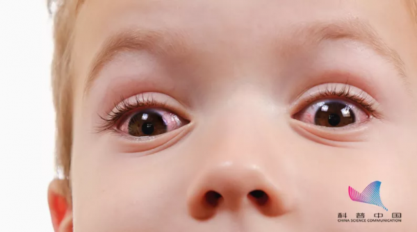 警惕！出現這樣的“紅眼”一定要當心！嚴重或可致盲