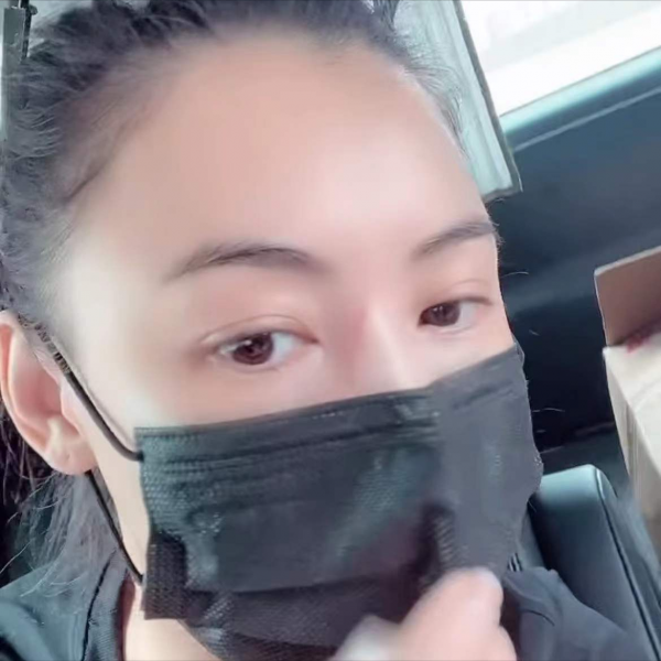 張柏芝被3歲小兒子抓傷臉部，傷口較長且深像刀疤一樣遮都遮不住