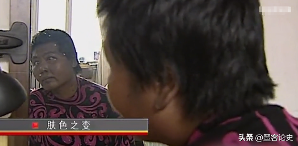 真實故事:山西45歲女子一夜變黑,體重急速增加,手術後讓家人落淚