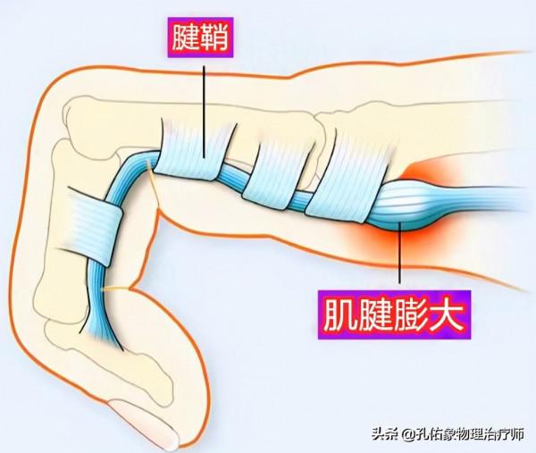 50歲左右的中老年人，手指僵硬、疼痛、怕冷、變形，預示哪些疾病