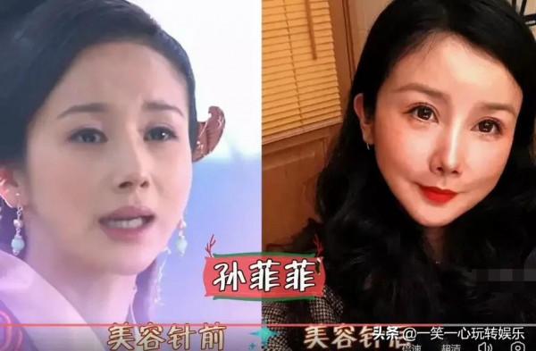 被“美容針”摧殘的女星，戚薇笑都不自然，舒暢真成“天山童姥”