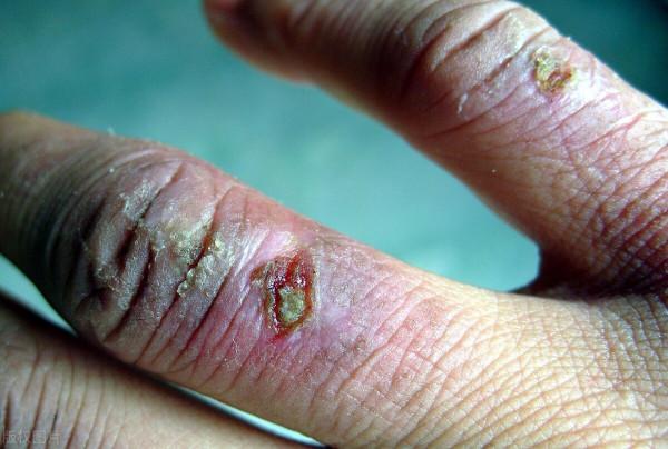 冬季手足紅斑乾裂 是溼疹還是凍瘡？1分鐘辨別，對症治療才有效