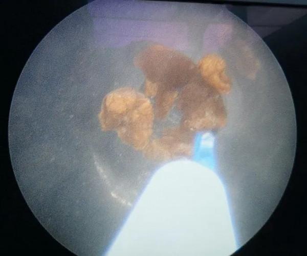 改變思維，就可能消除鐳射碎石粉塵引起的視野模糊？