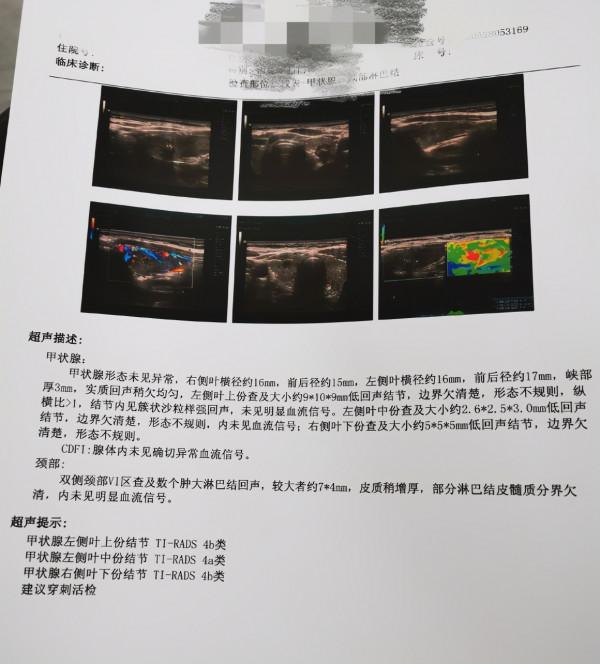 脖子成“天氣預報員”,18歲少女感冒查出甲癌 脖子成“天氣預報員”,18歲少女感冒查出甲癌
