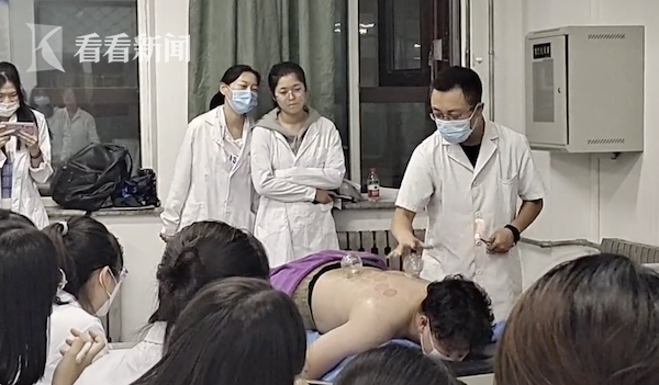 老師課堂上演示拔火罐 網友：還差志願者嗎