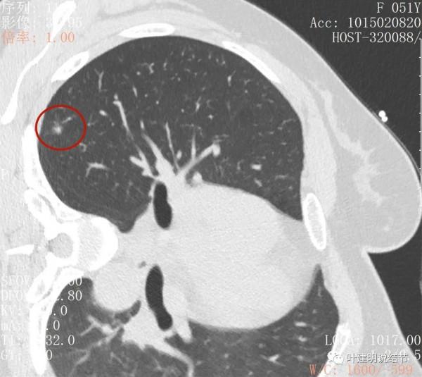 指南說小於5毫米的肺結節不需要隨訪，打臉來了