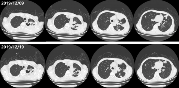 中年男性反覆發熱、咳嗽、咳痰,肺部陰影緣何而生? 中年男性反覆發熱、咳嗽、咳痰,肺部陰影緣何而生?