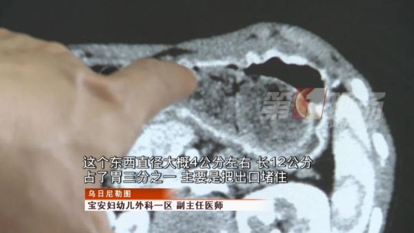 女童腹痛,竟是吃的東西“不尋常”……它們佔了胃部三分之一 女童腹痛,竟是吃的東西“不尋常”……它們佔了胃部三分之一