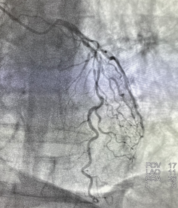 山東第一醫科大學附屬省立醫院心內科率先在省內開展準分子鐳射斑塊消蝕術(ELCA)