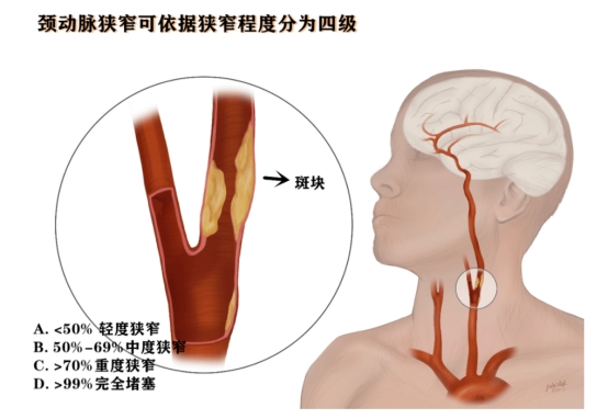 為什麼愛喝酒的人，容易得腦梗塞？這4個原因是關鍵