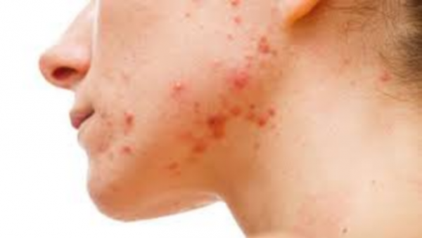 長了痘痘，這三大食物要少吃，但是這幾類要多吃