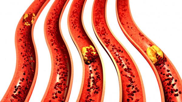 中年男子，頸動脈斑塊，吃了5年他汀，看看現在的檢查化驗結果