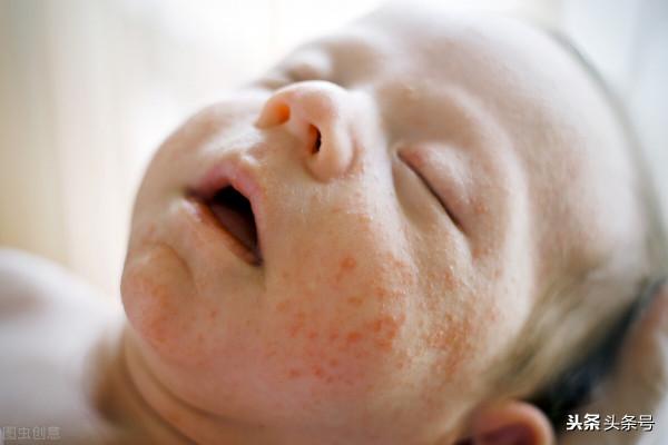 寶寶反覆溼疹,看著鬧心,居家護理有何小妙招呢? 寶寶反覆溼疹,看著鬧心,居家護理有何小妙招呢?