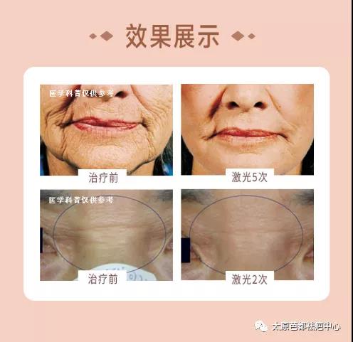 關於M22 AOPT超光子嫩膚,你最想知道的答案點選收看 關於M22 AOPT超光子嫩膚,你最想知道的答案點選收看