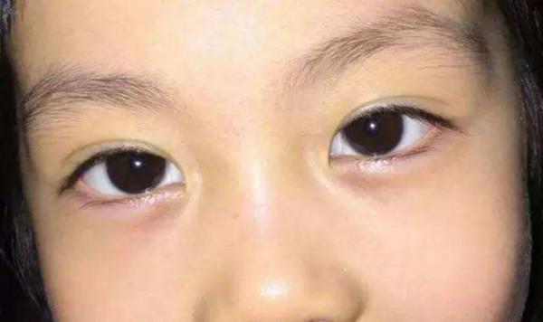 6歲女孩眼袋大，被診斷為脾虛，面部出現四種問題，及時健脾