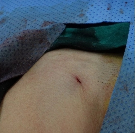 北京同仁醫院血管外科成功開展首例主動脈支架“開窗”術 北京同仁醫院血管外科成功開展首例主動脈支架“開窗”術