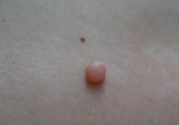 醫生眼中善良的6種“瘤”,查出來別怕,不會惡化,有的根本不是腫瘤 醫生眼中善良的6種“瘤”,查出來別怕,不會惡化,有的根本不是腫瘤