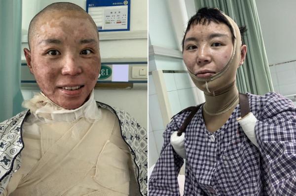 美媽凌晨拔火罐欲解痠痛，不料發生悲劇，從此全身戴上“緊箍咒”