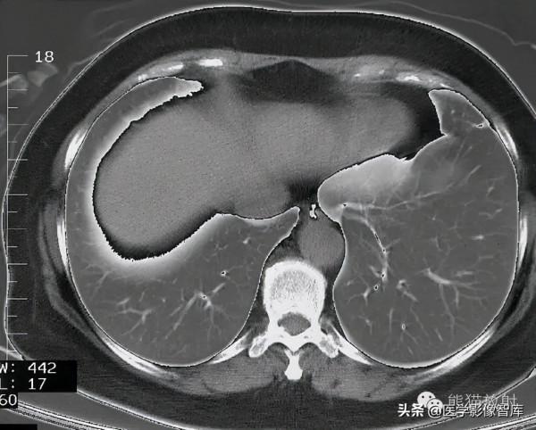CT斷層解剖圖譜最全總結「推薦收藏」 CT斷層解剖圖譜最全總結「推薦收藏」